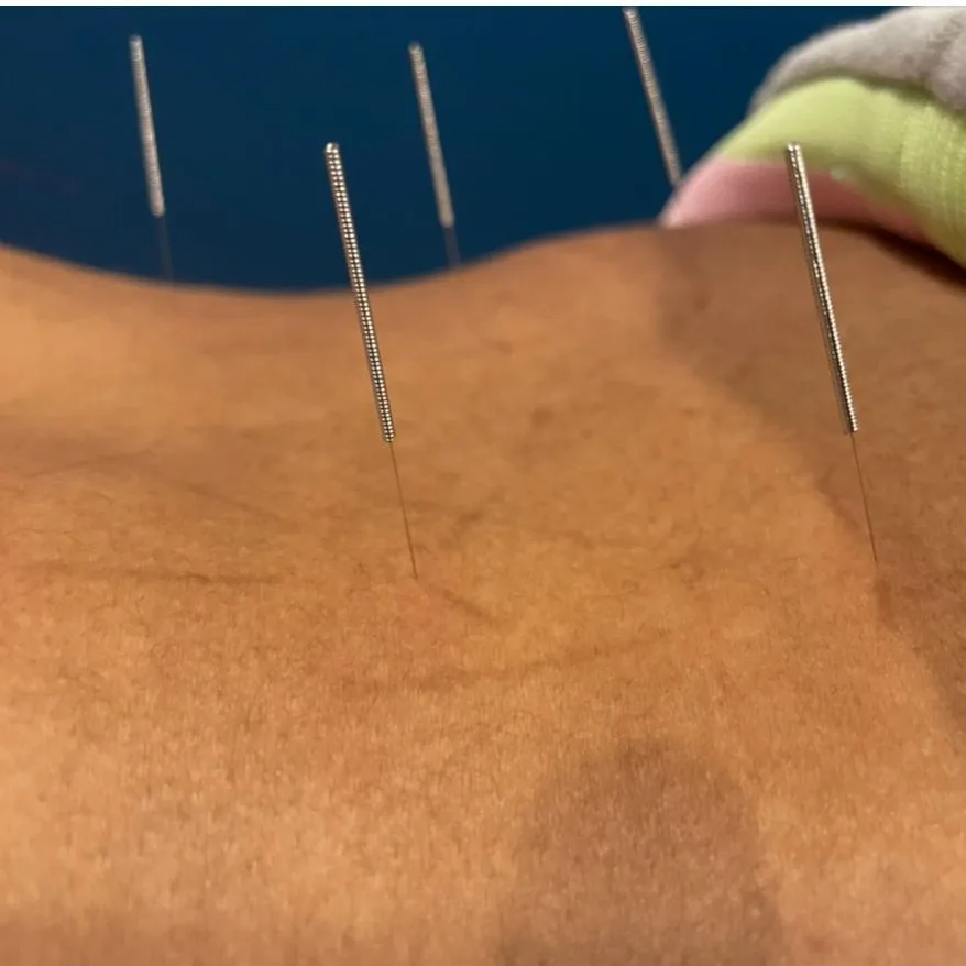 Acupuncture treatment with fine needles at Juarez Chiropractic in Chicago